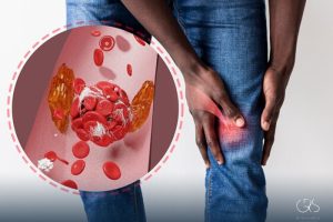 Vasculitis treatment: Understanding an Inflammatory Disease