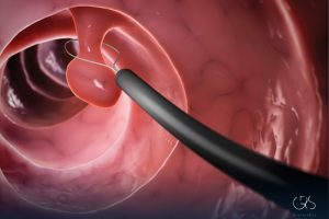 Colonoscopy Preparation: A Comprehensive Guide