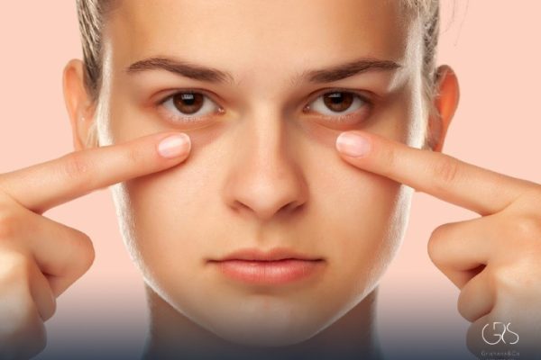 Dark Circles Under the Eyes: Quick Fixes