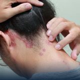 Scalp Psoriasis Symptoms: Expert Tips for Treatment