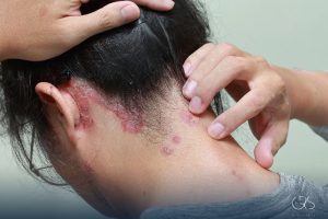 Scalp Psoriasis Symptoms: Expert Tips for Treatment