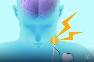 Vagus Stimulation Benefits: Exploring Its Potential