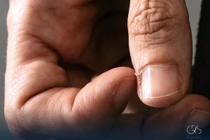 Hangnail Treatment: Prevention and Care